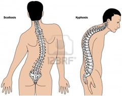 drawing-of-spine-deformities-scoliosis-and-kyphosis-curvature-of-the-spine-and-hunchback-or-round-ba