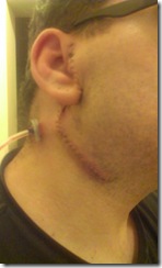 parotid gland surgery week 2