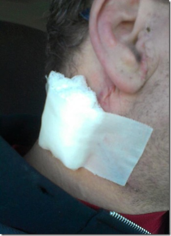 tube removed december 6th